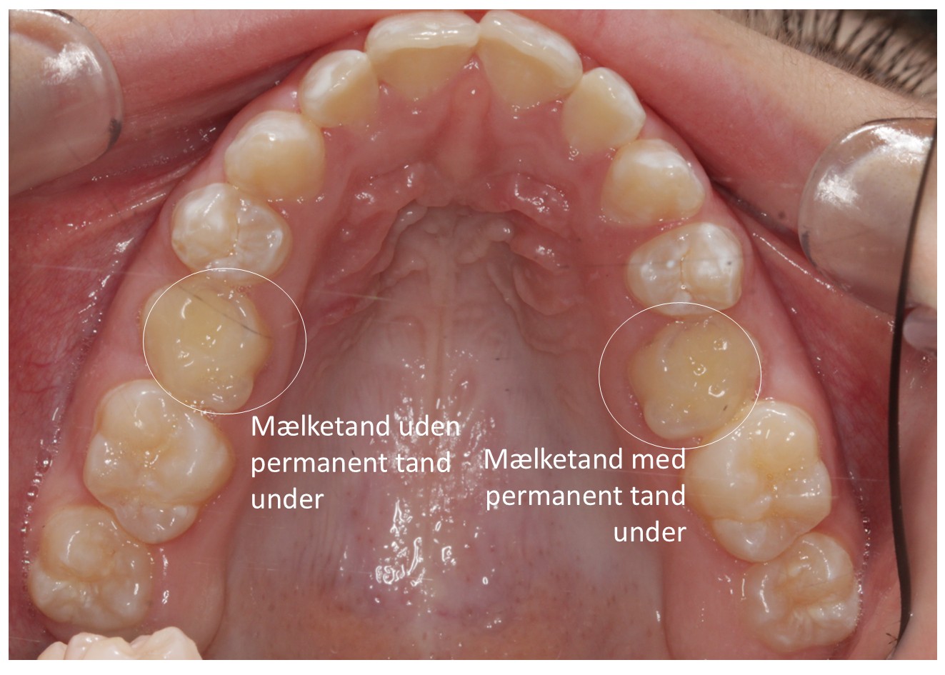 Bendeslider-Meselizer-bøjle-tandregulering (3)