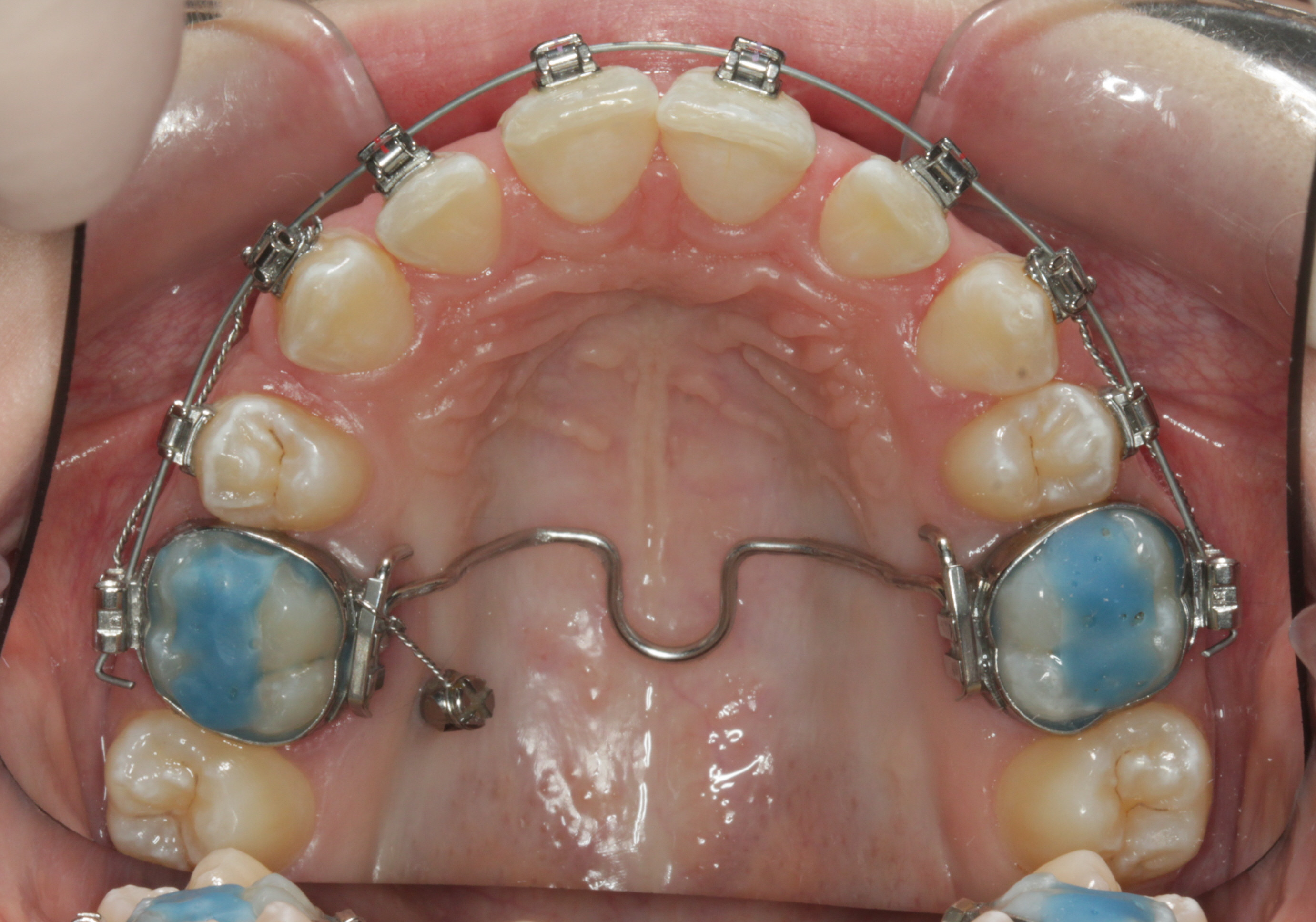 Tads-mini-skrue-forankring-tandregulering (1)