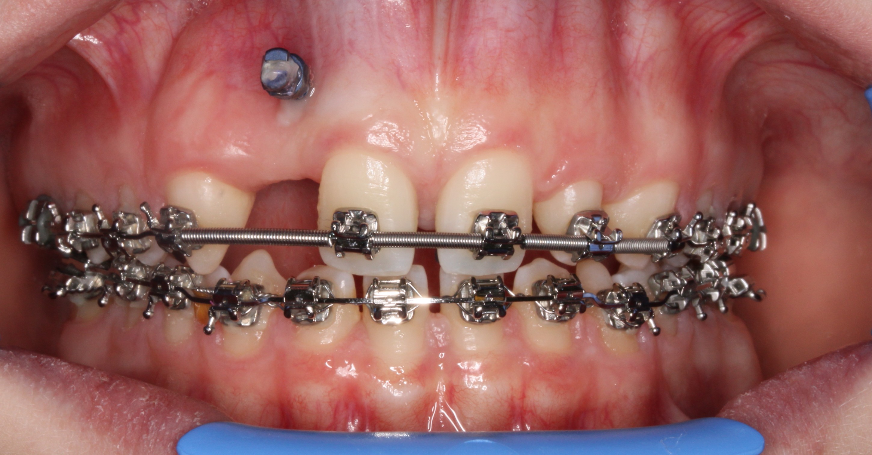 Tads-mini-skrue-forankring-tandregulering (4)