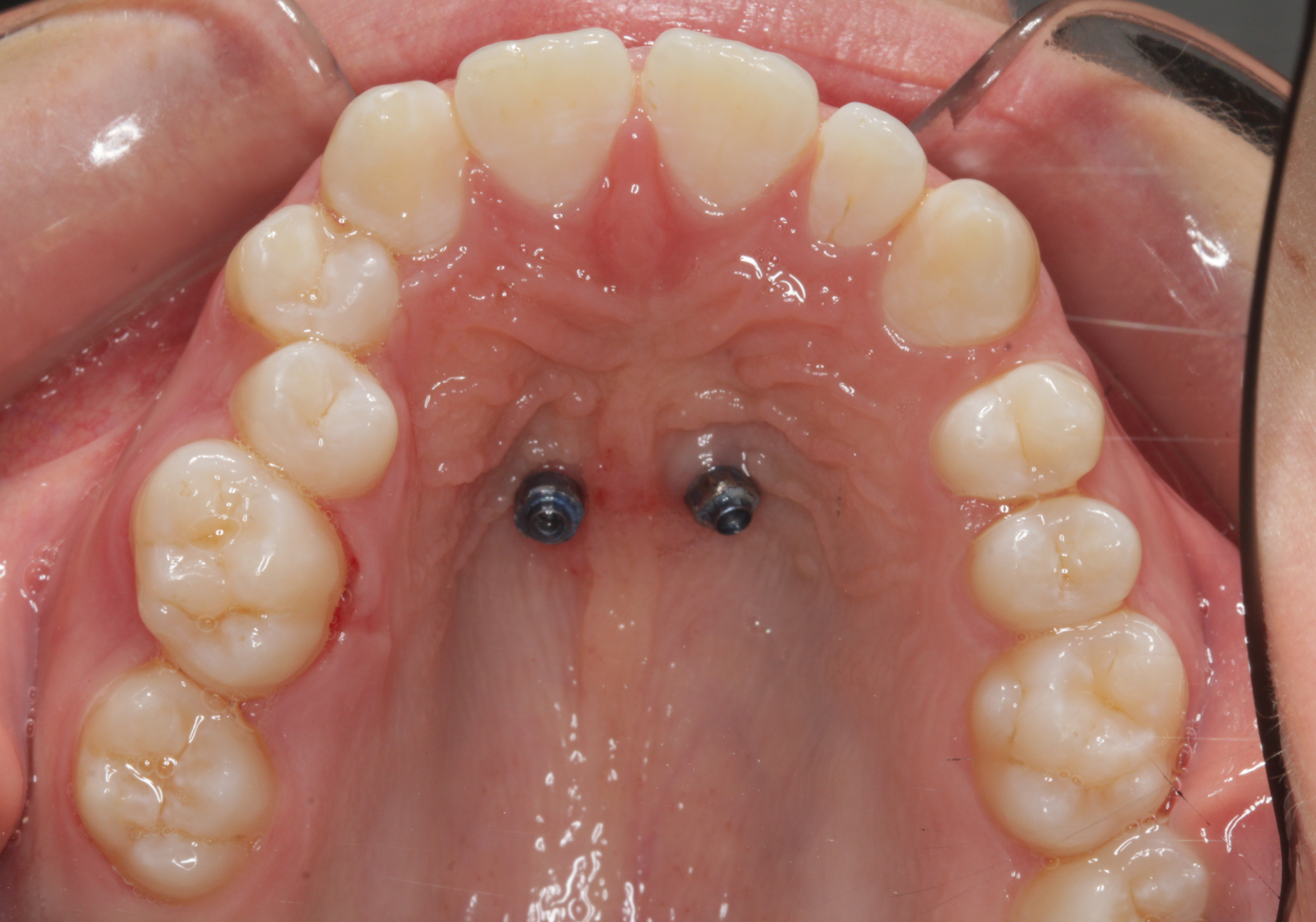 Tads-mini-skrue-forankring-tandregulering (5)