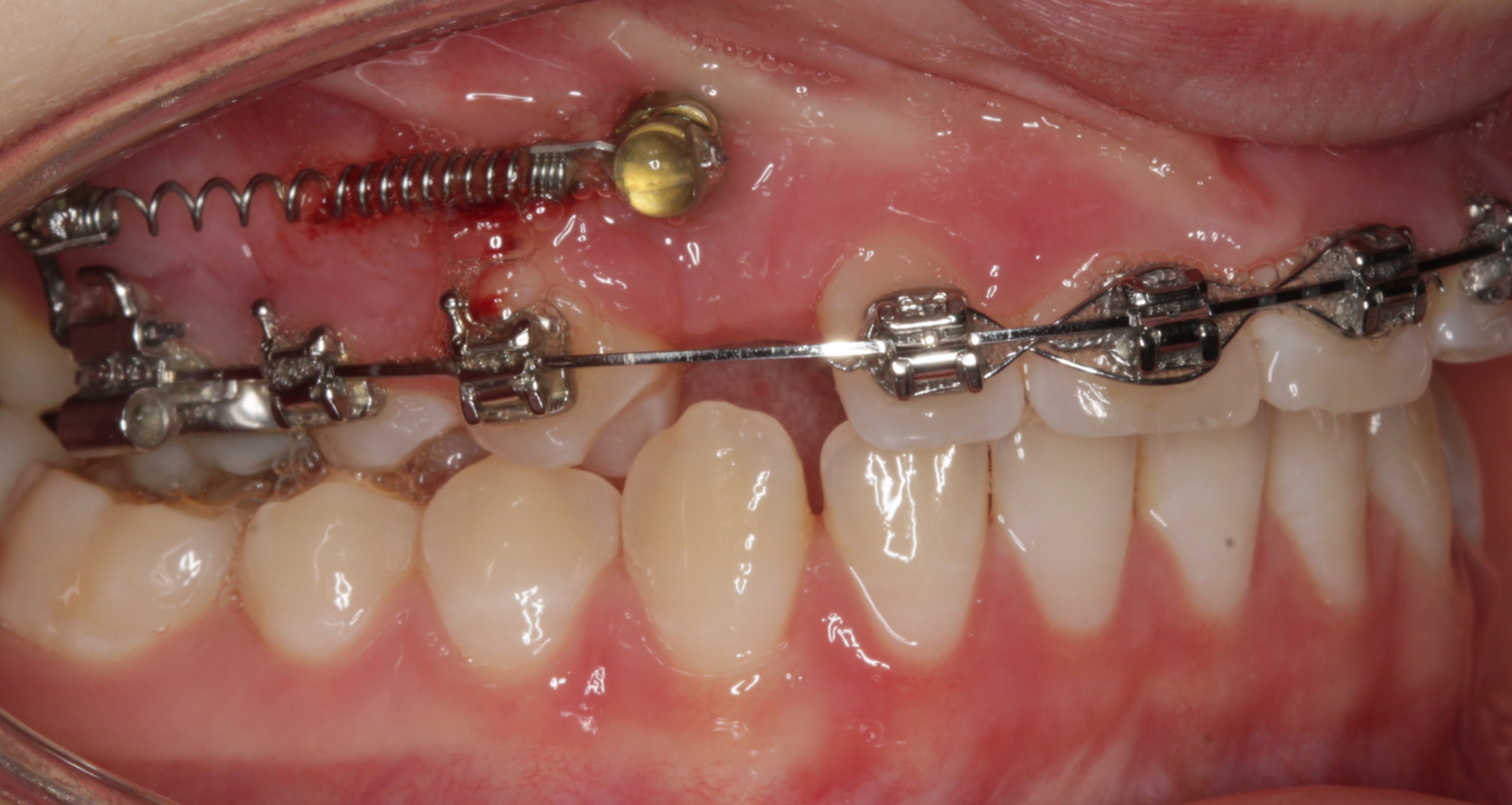 Tads-mini-skrue-forankring-tandregulering (6)