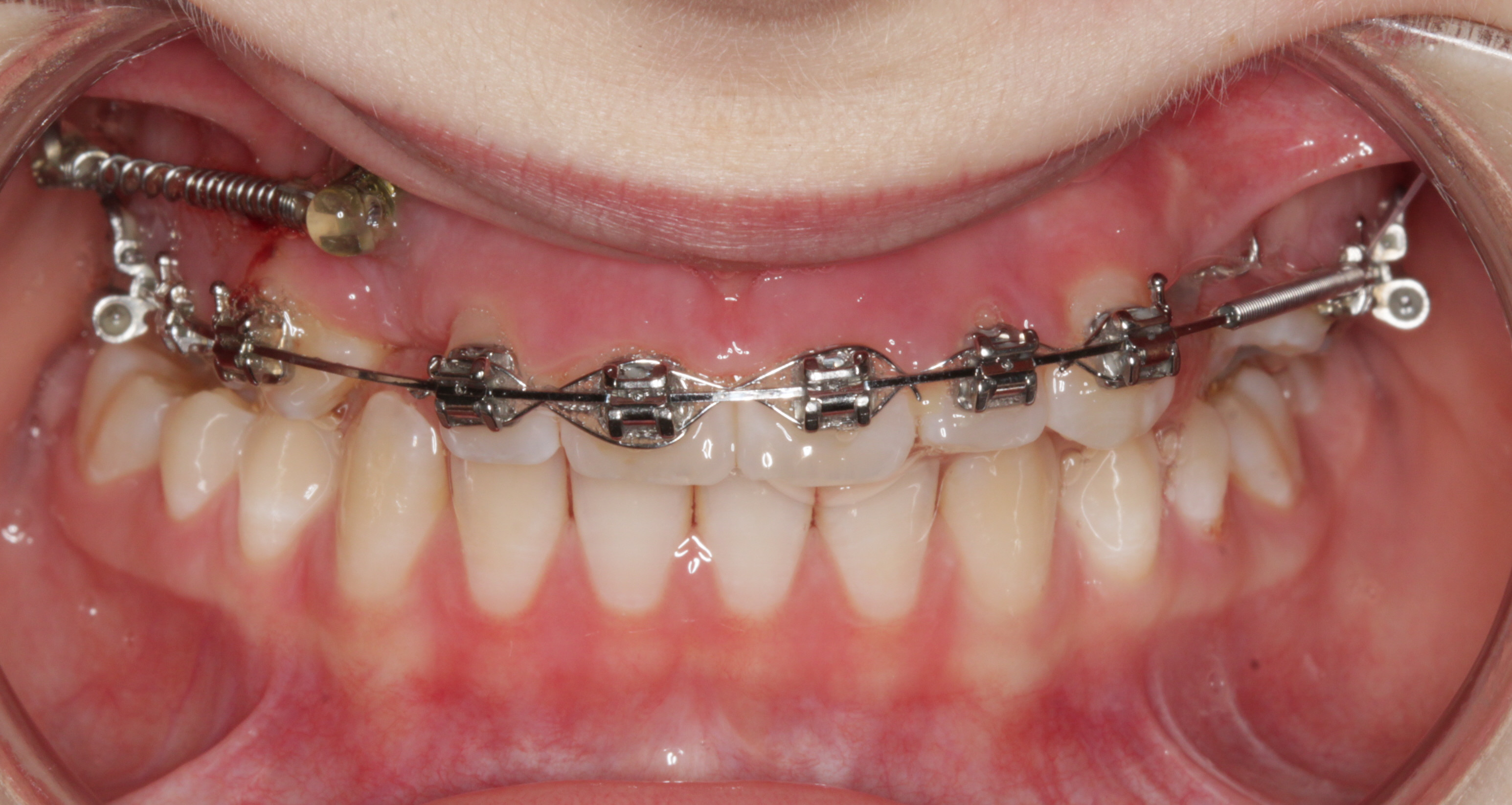 Tads-mini-skrue-forankring-tandregulering (7)