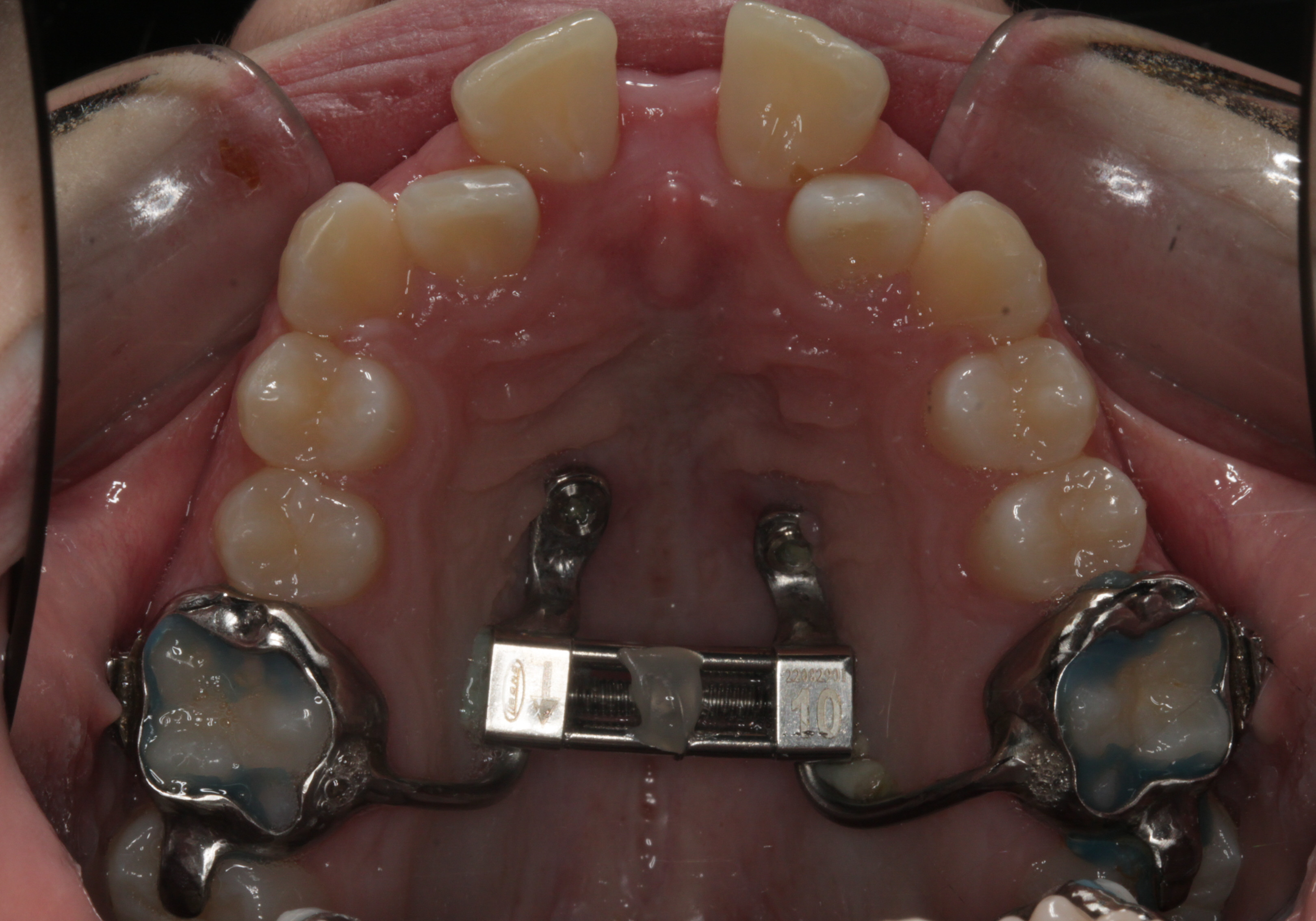 hyxar-case2-4